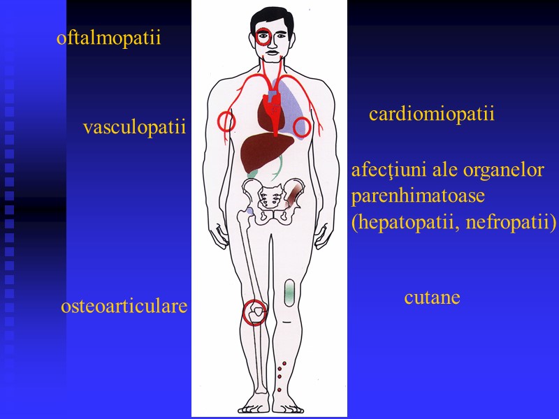 oftalmopatii afecţiuni ale organelor parenhimatoase (hepatopatii, nefropatii) cutane osteoarticulare cardiomiopatii vasculopatii